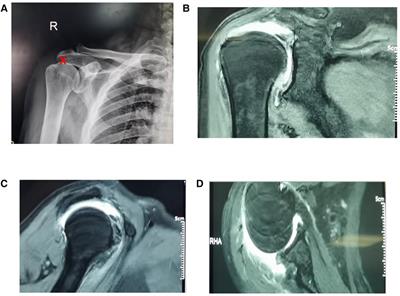 Study of arthroscopic superior capsule reconstruction in the treatment of irreparable rotator cuff tears